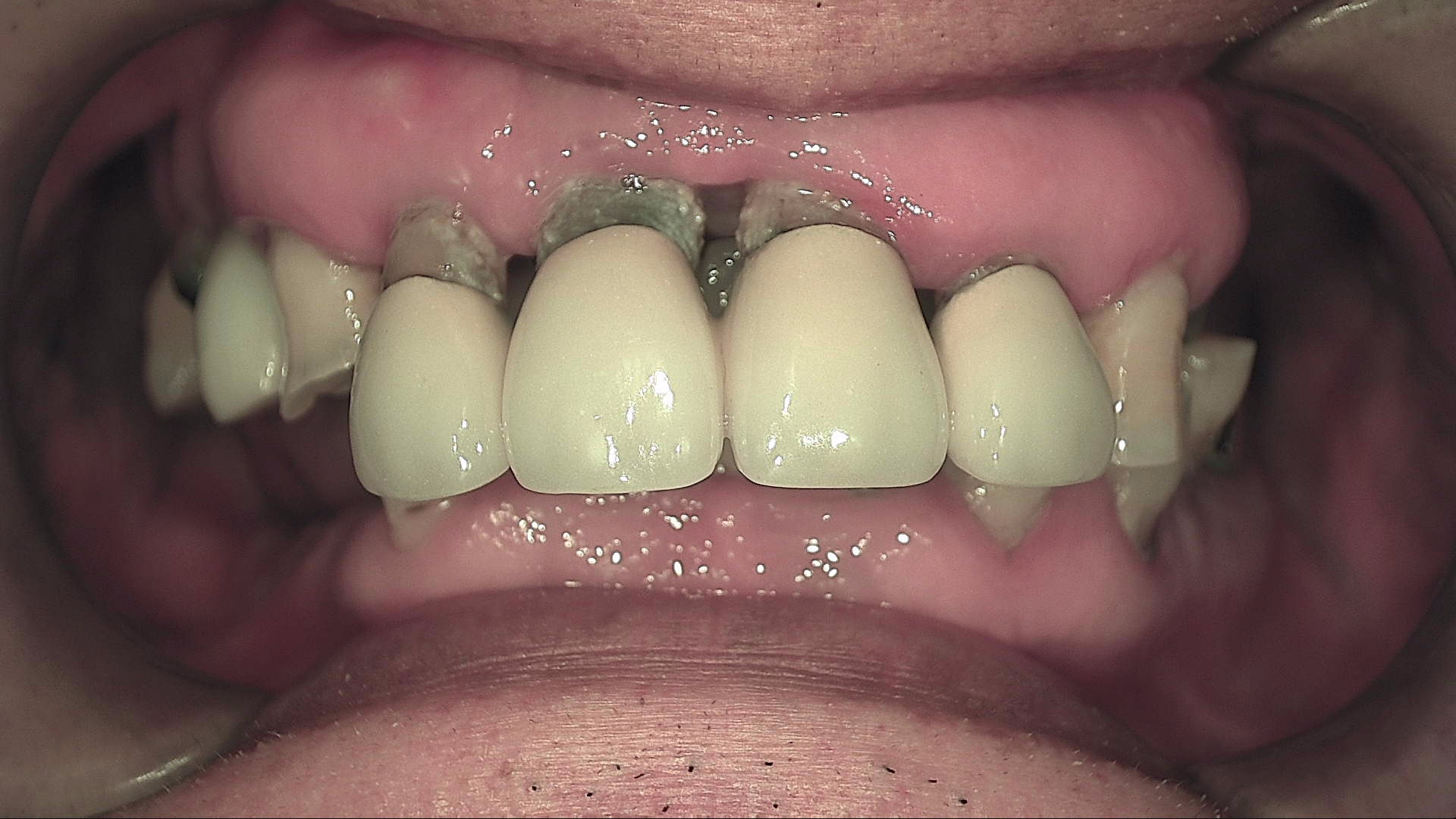 IMPLANT CASE - Before